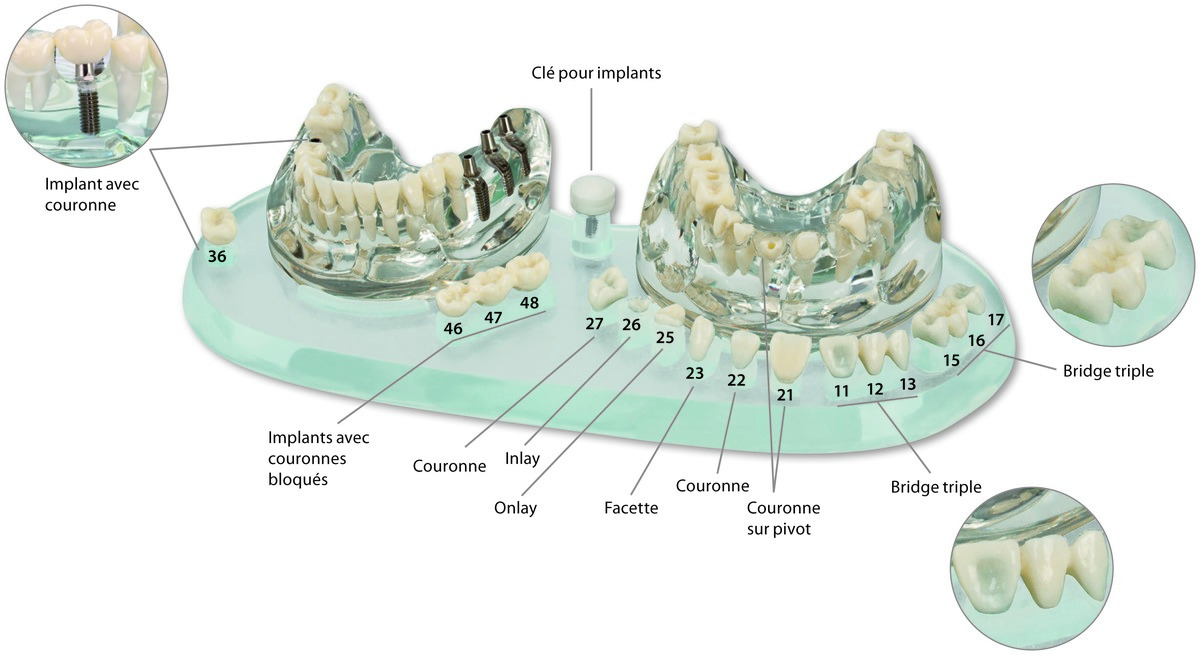 STUDY MODEL DEMO IMOLANT C + B 355638 HAGER STUDY MODEL DEMO IMOLANT C + B 355638 HAGER