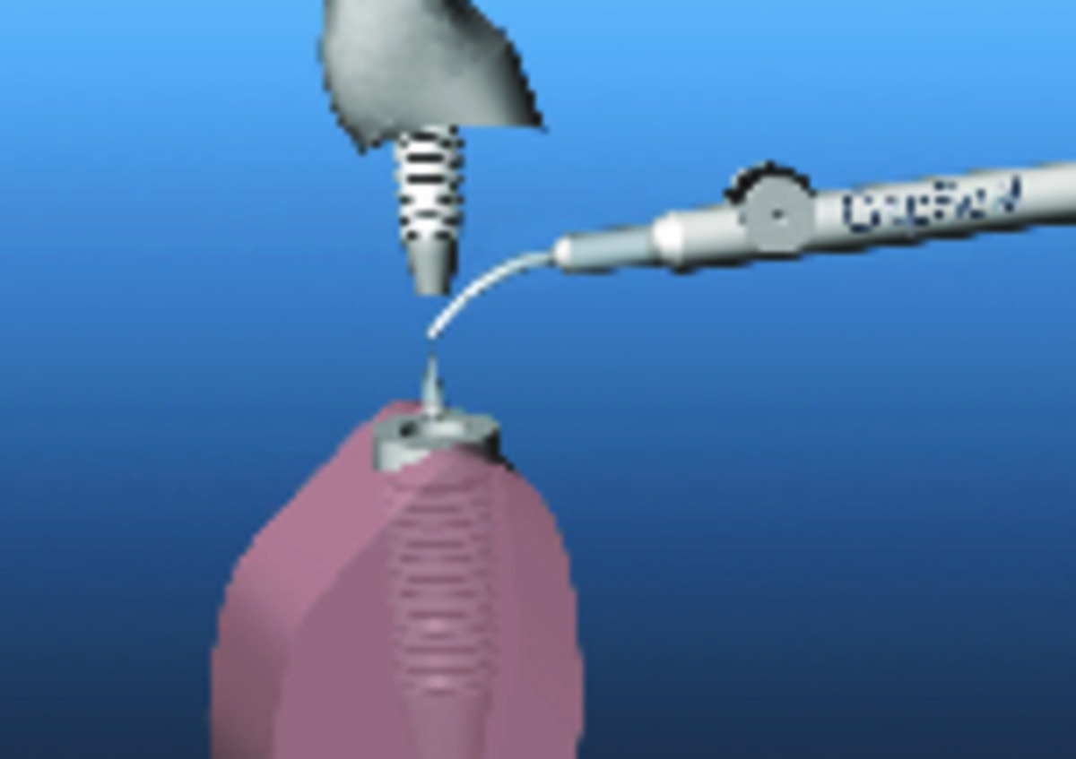 GapSeal HAGER &WERKEN - Le set (1 applicateur + 10 embouts) GapSeal HAGER &WERKEN - Le set (1 applicateur + 10 embouts)