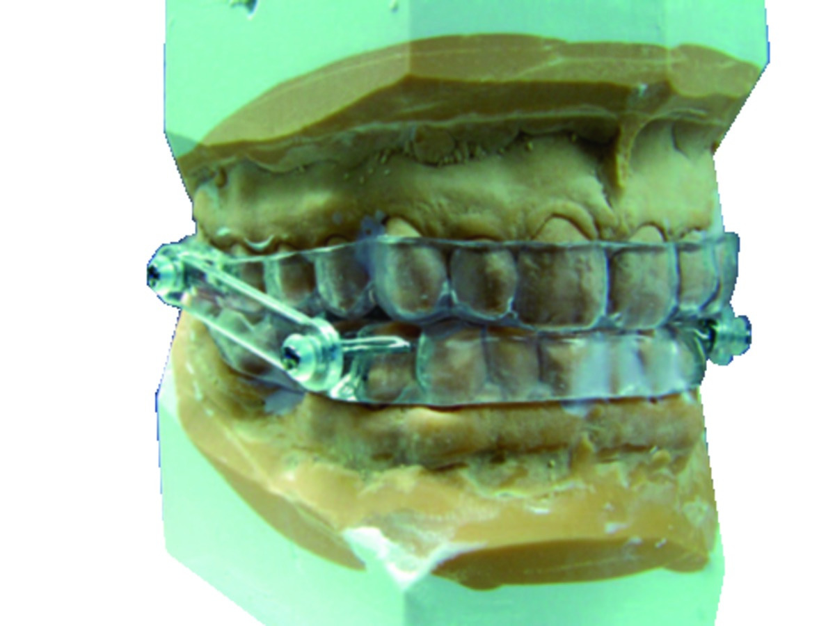 OPM Kit SCHEU DENTAL - Le kit OPM