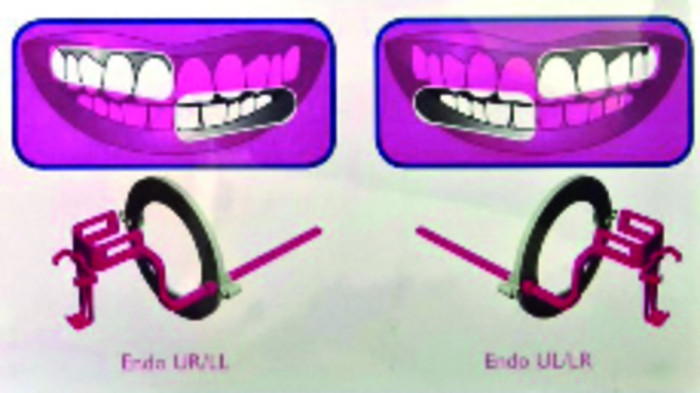 Endo Roses Arcade Dentaire - Angulateurs Opteo OWANDY - Taille 1 Endo - Rose ...